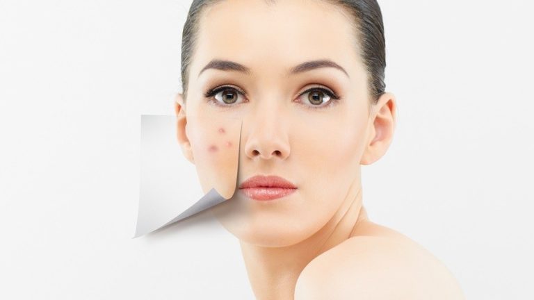 How To Get Rid Of Acne Scarring For Good